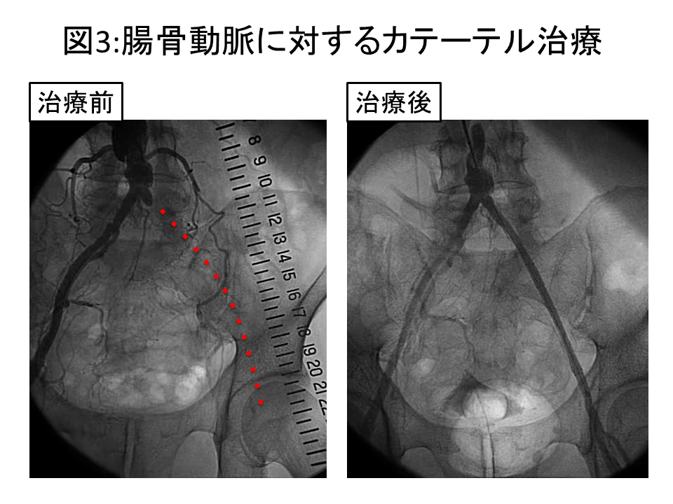図3 図1:人工血管置換術