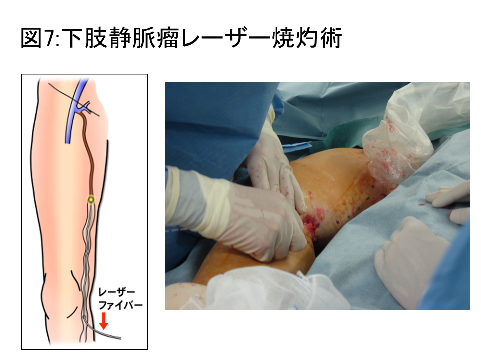 図7：下肢静脈瘤レーザー焼灼術